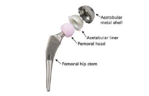 Diagram of exactech hip replacement