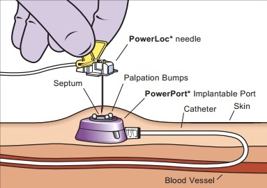 diagram showing how a powerport catheter device works